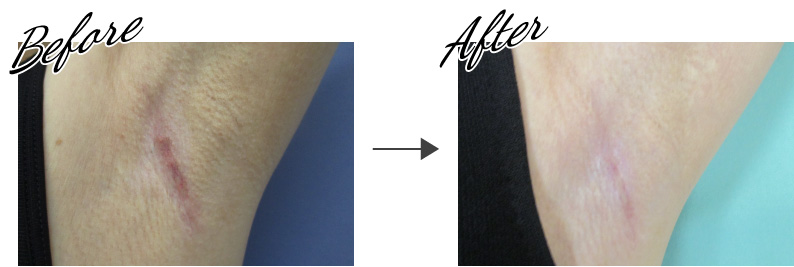 左脇：Before → After